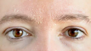 Dry or Flaky Skin
