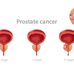 Prostate Cancer