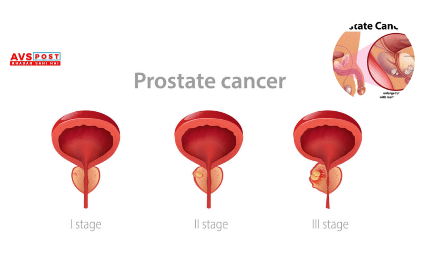 Prostate Cancer : Awareness, Advances, and Stories of Strength