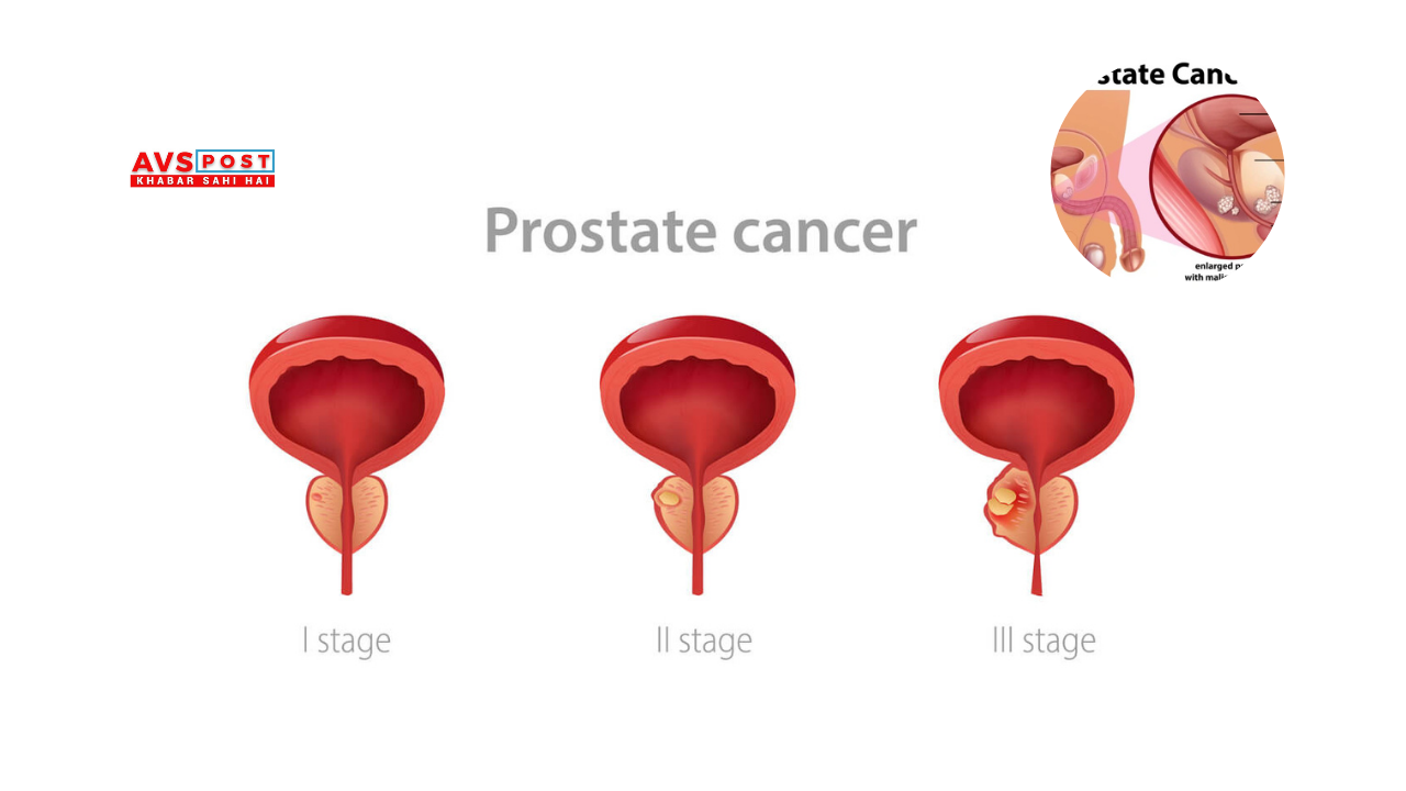 Prostate Cancer
