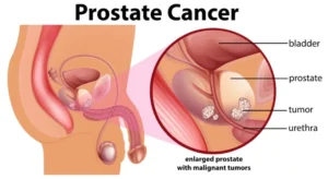 Prostate cancer : most common cancers affecting men worldwide