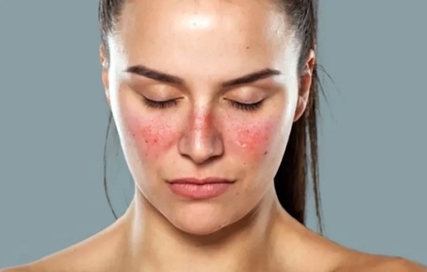 Lupus Disease : Symptoms, Causes, Diagnosis, and Treatment – A Complete Guide