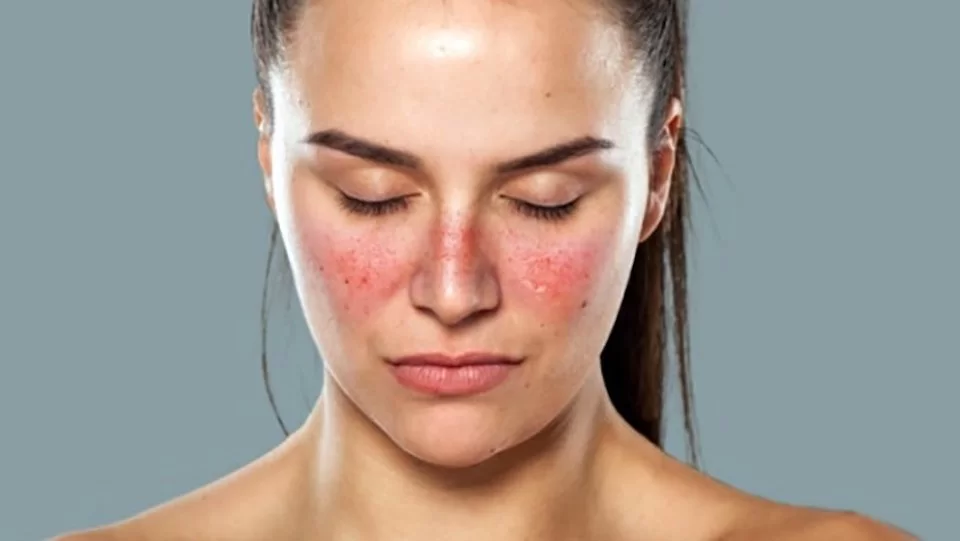Lupus Disease